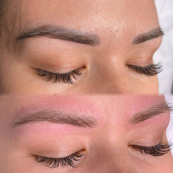 Remoção a Laser de Tatuagem e Micropigmentação - 2