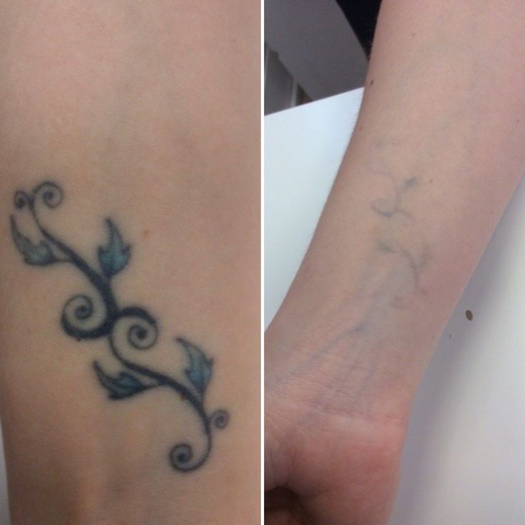 Remoção a Laser de Tatuagem e Micropigmentação - 3